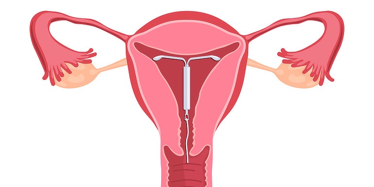 Nitroděložní tělísko možná snižuje riziko vzniku rakoviny děložního čípku