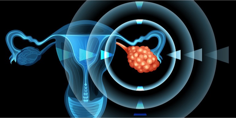 Vyšetření stěru z děložního čípku: možné využití při detekci rakoviny vaječníků a dělohy?