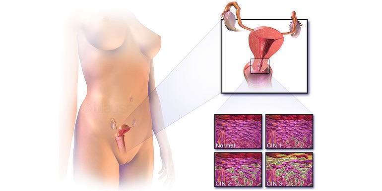 Nový test má velmi vysokou citlivost pro karcinom děložního hrdla